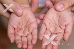 ХӨСҮТ: Улаанбурхан өвчний батлагдсан тохиолдол 2 нэмэгджээ